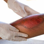 Injury_RoadRash Injury_RoadRash